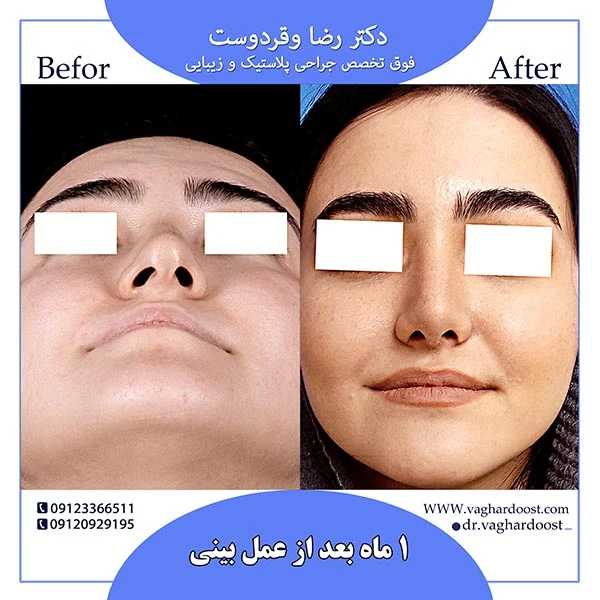 جراحی | جراحی بینی صفر تا صد جراحی بینی (رینوپلاستی)