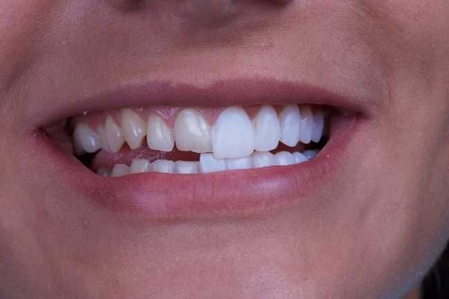 نکاتی برای پیشگیری از کج شدن دندان ها