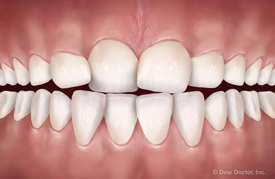 نکاتی برای پیشگیری از کج شدن دندان ها