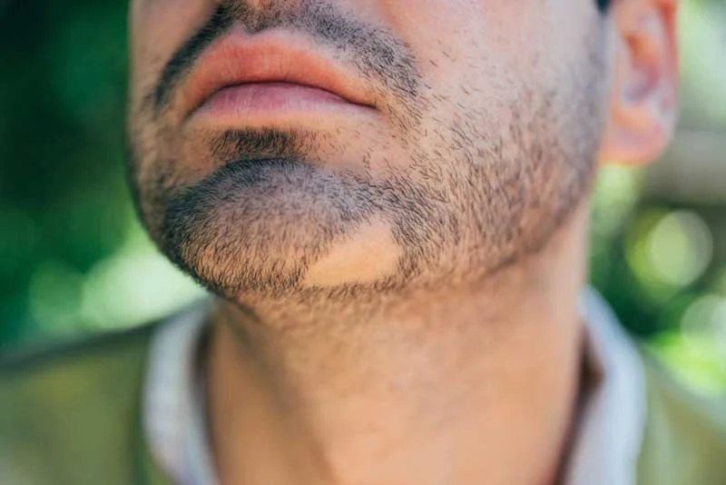 آیا ریزش مو سکه ای خطرناک است؟