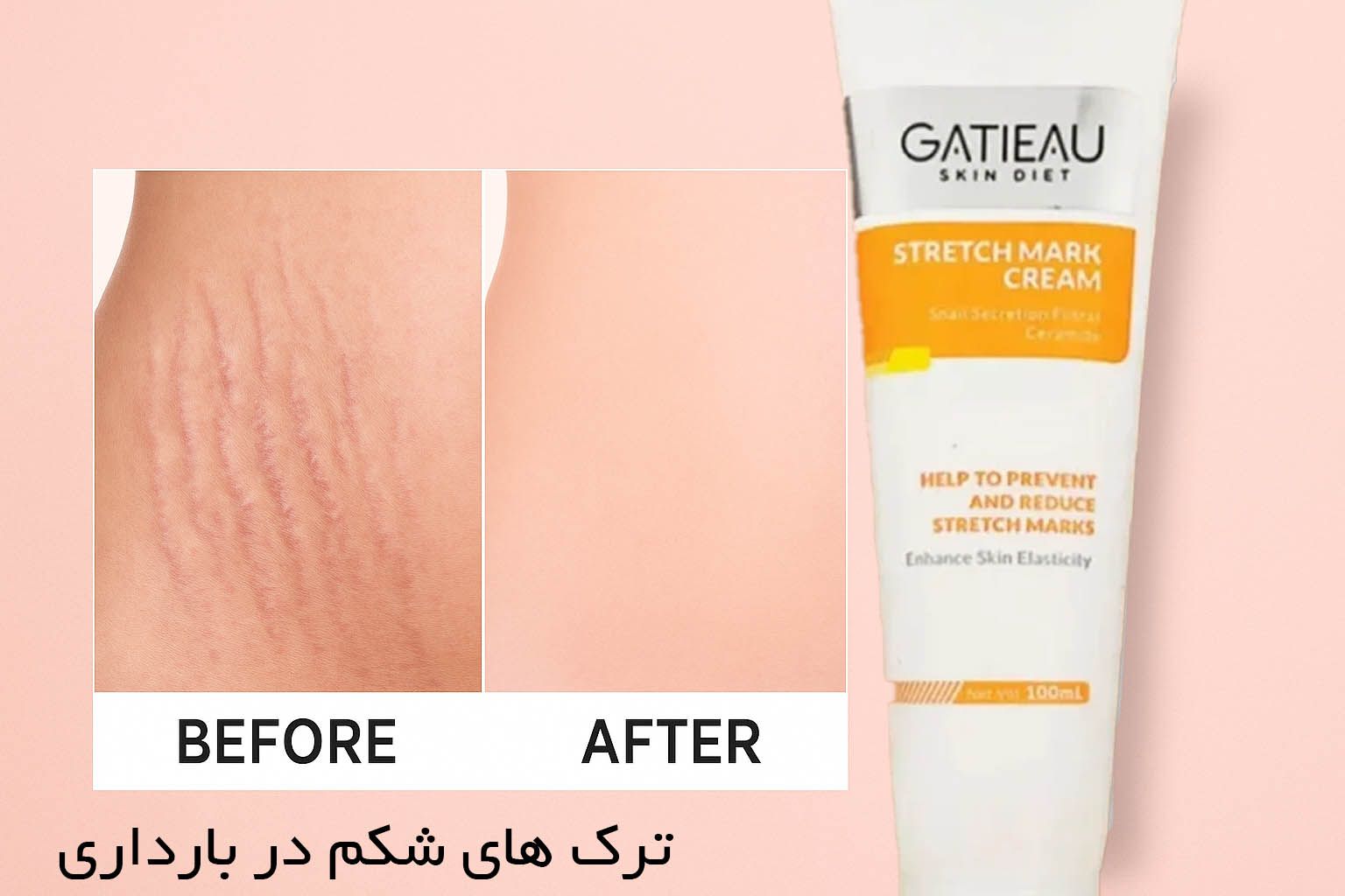 بهترین کرم برای جلوگیری از ترک شکم در بارداری