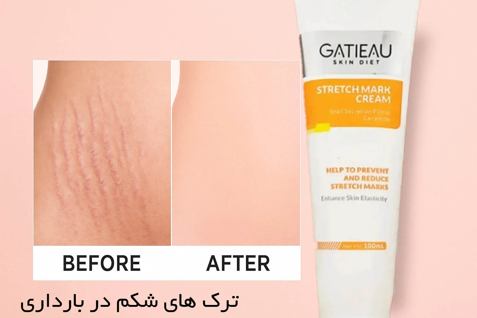 بهترین کرم برای جلوگیری از ترک شکم در بارداری