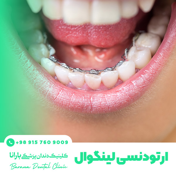 انواع ارتودنسی دندان + راهنمای انتخاب بهترین روش