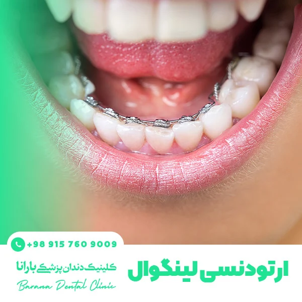 انواع ارتودنسی دندان + راهنمای انتخاب بهترین روش