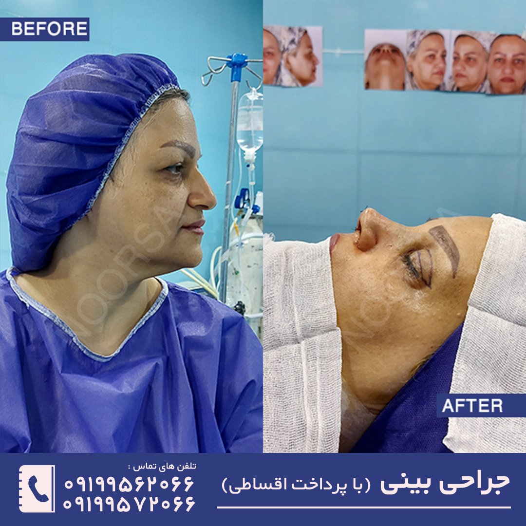 نمونه قبل و بعد از عمل بینی