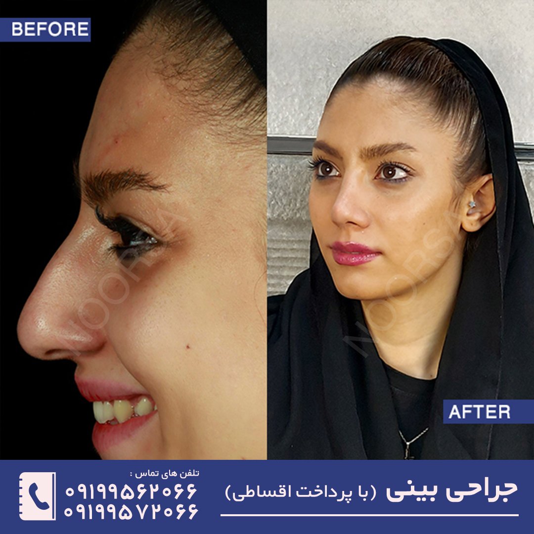 نمونه قبل و بعد از عمل بینی