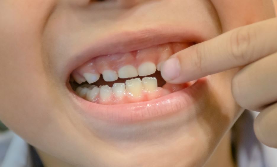 دندانپزشکی | عفونت برای افتادن دندان شیری چه باید کرد