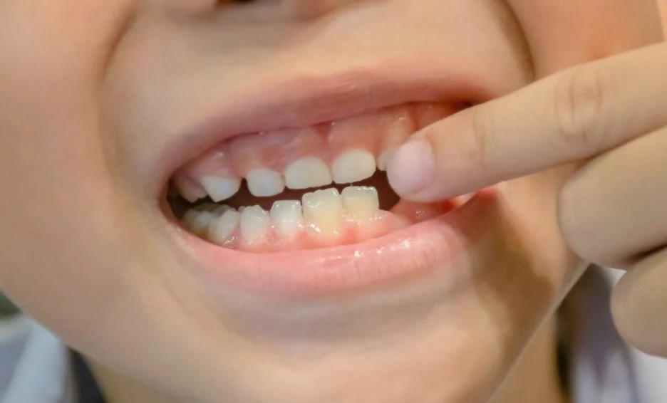 برای افتادن دندان شیری چه باید کرد؟