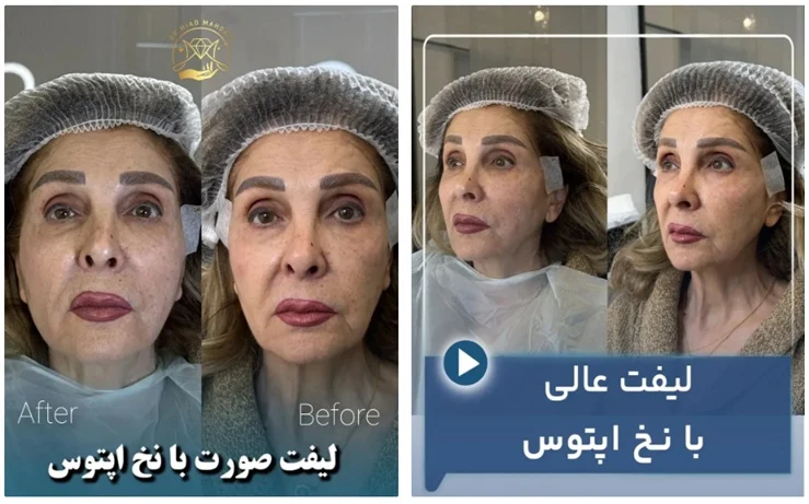 جراحی | ساعت ۱۰ سال جوانتر در ۱ ساعت: ۴ فایده لیفت با نخ که شما را از جراحی بینیاز میکند!
